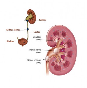 Kidney-Stone-Remedies